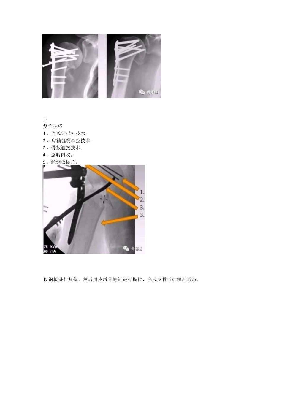 肱骨近端骨折的显露和 复位技术_第6页