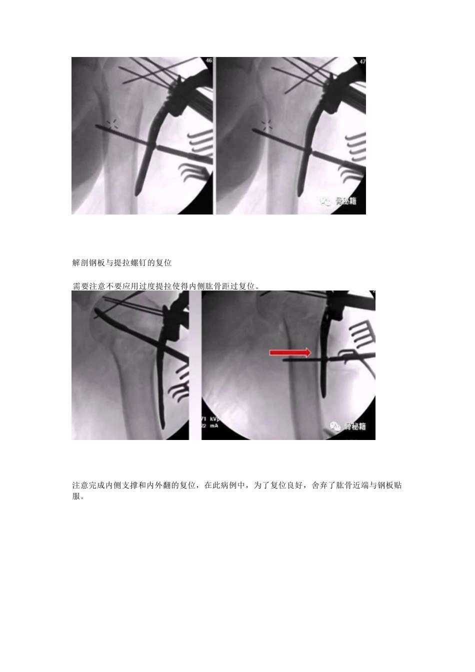 肱骨近端骨折的显露和 复位技术_第9页