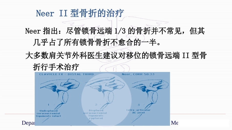 锁骨远端骨折伴肩锁关节脱位的治疗_第10页