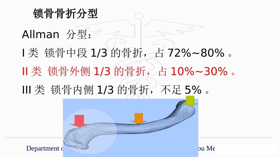 锁骨远端骨折伴肩锁关节脱位的治疗_第2页