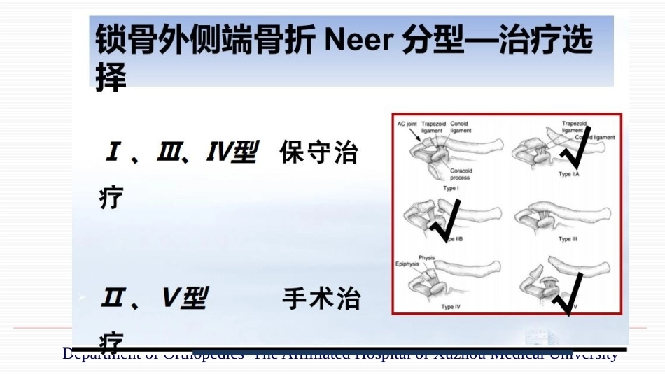锁骨远端骨折伴肩锁关节脱位的治疗_第9页