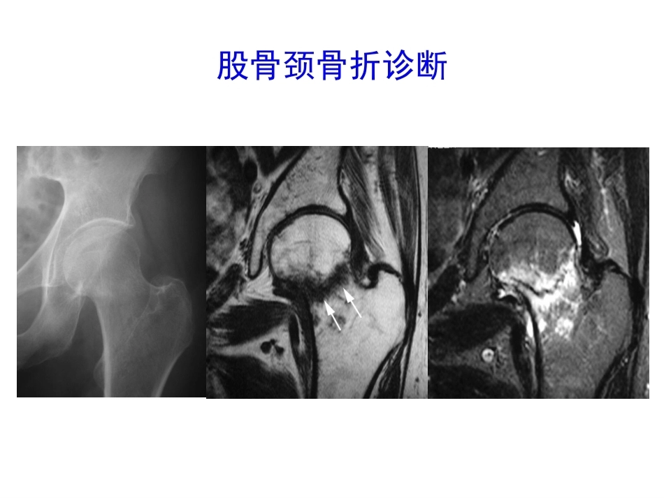 股骨颈骨折的诊断和治疗翻译_第11页