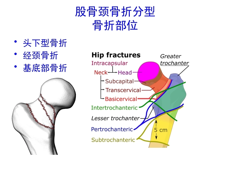 股骨颈骨折的诊断和治疗翻译_第5页