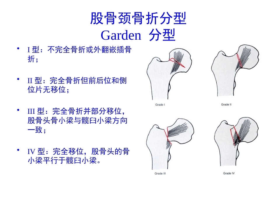 股骨颈骨折的诊断和治疗翻译_第6页