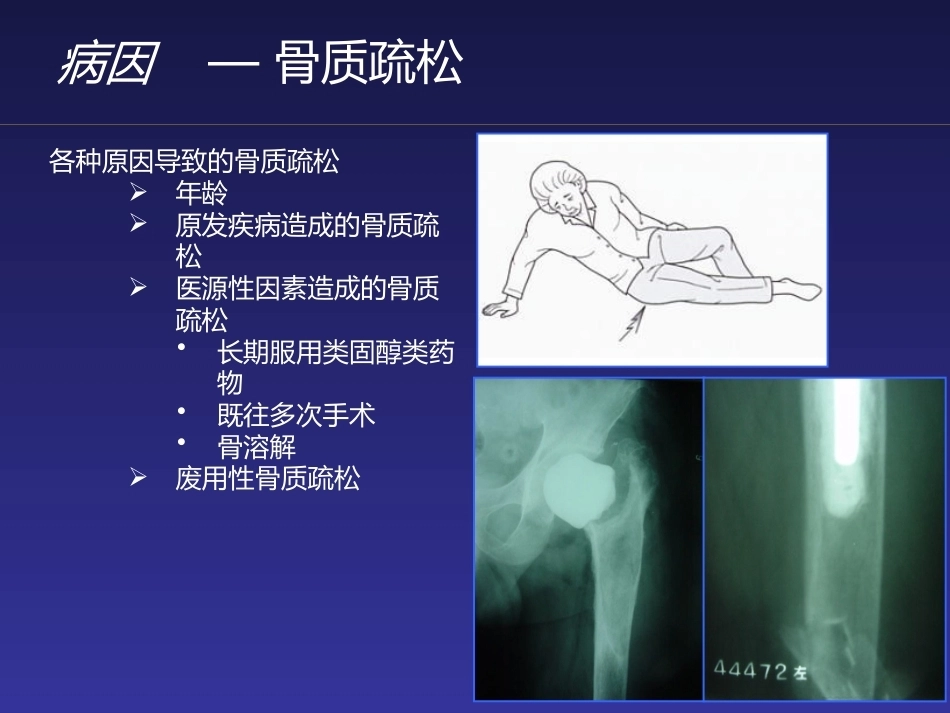 假体周 围骨折_第10页