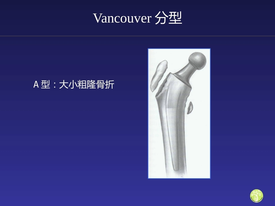 假体周 围骨折_第14页