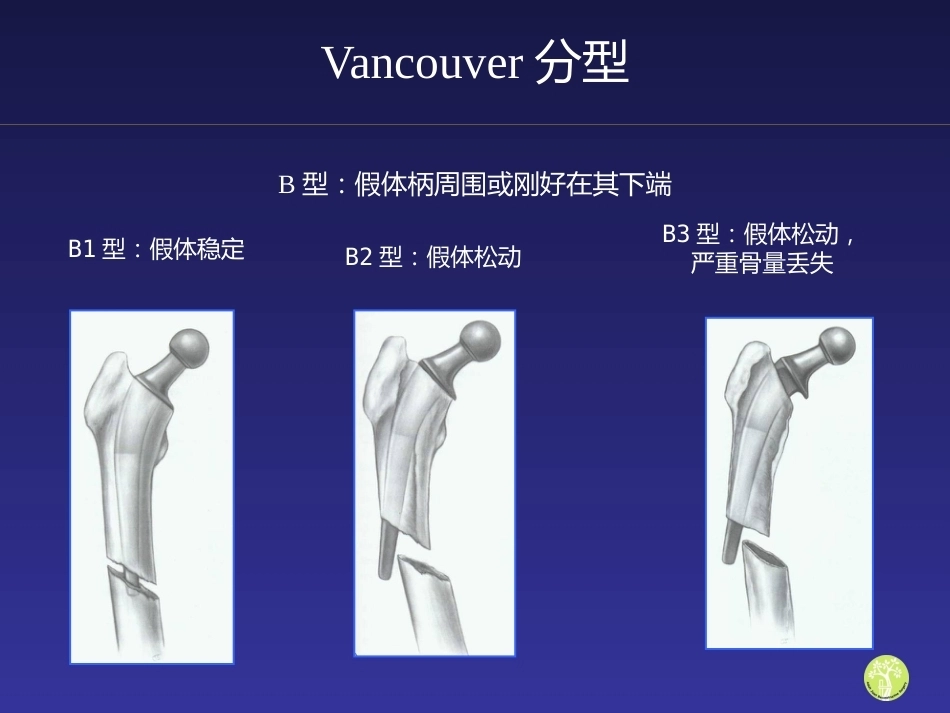 假体周 围骨折_第15页