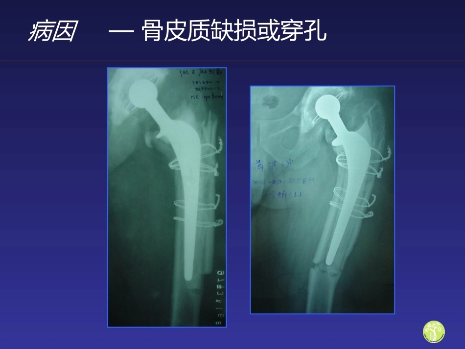 假体周 围骨折_第7页