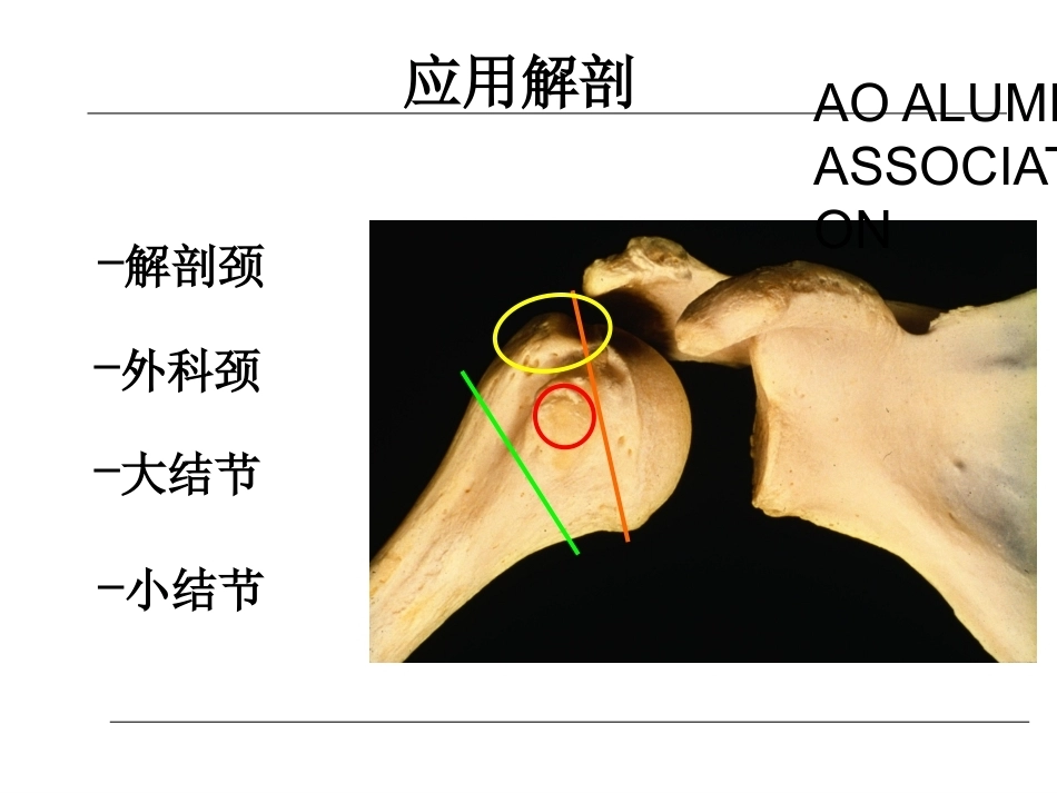 肱骨近端骨折的诊治_第4页