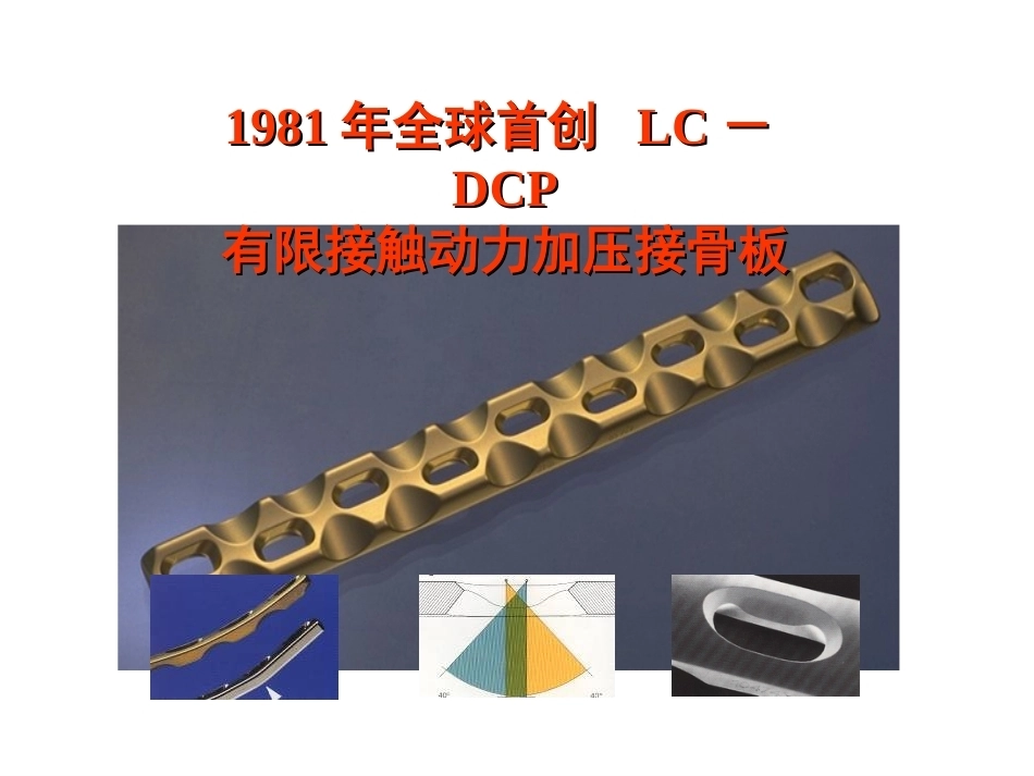 骨折内固定方案及选择原则_第15页