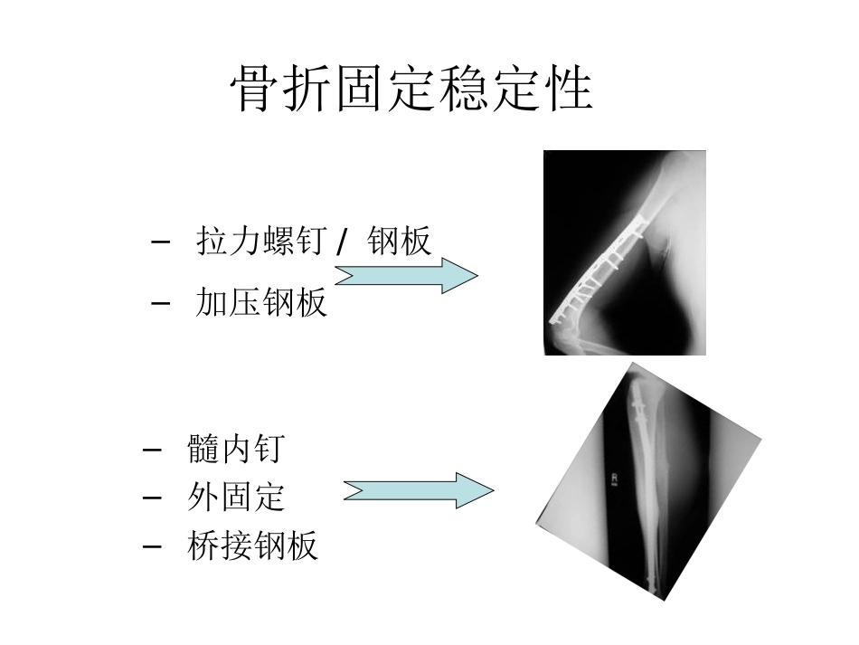 骨折内固定方案及选择原则_第4页