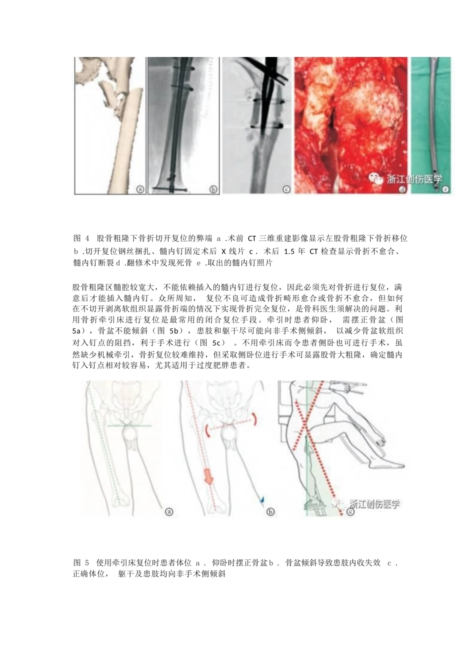 股骨粗隆下骨折髓内钉固 定的复位技术_第3页