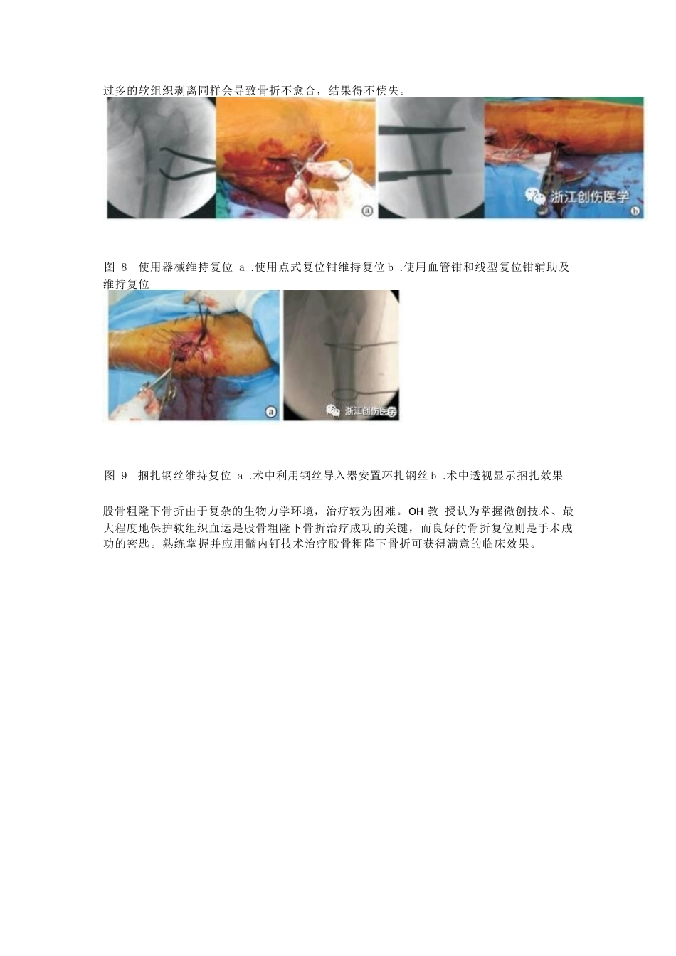股骨粗隆下骨折髓内钉固 定的复位技术_第5页