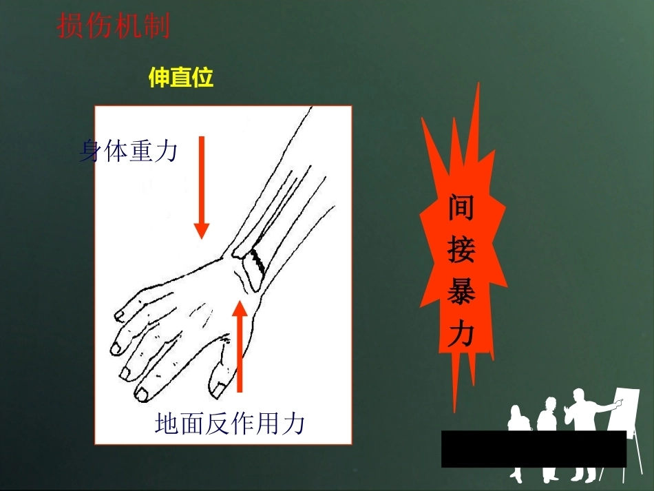桡骨远端骨折分型_第10页