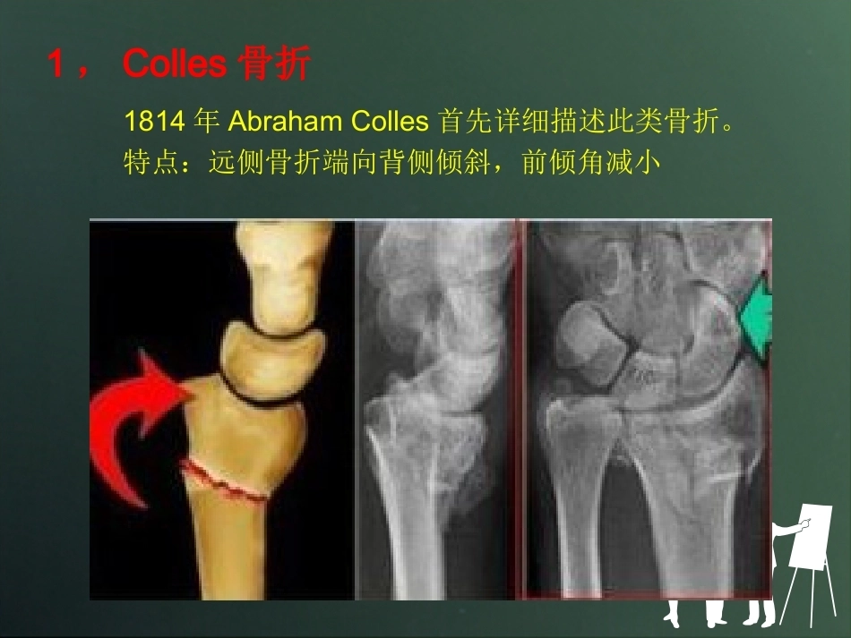 桡骨远端骨折分型_第14页