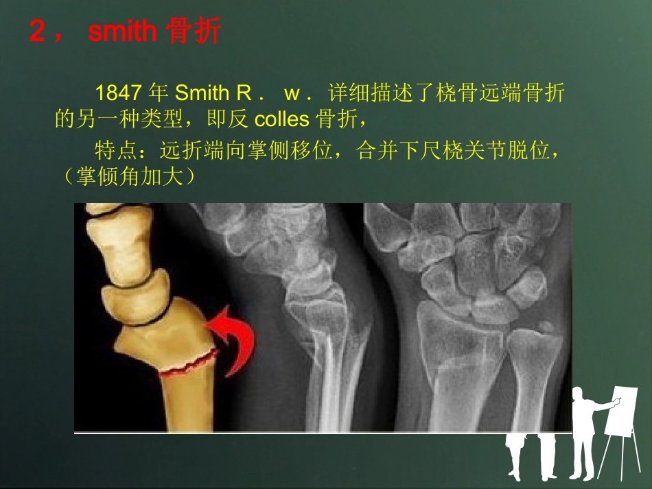 桡骨远端骨折分型_第15页