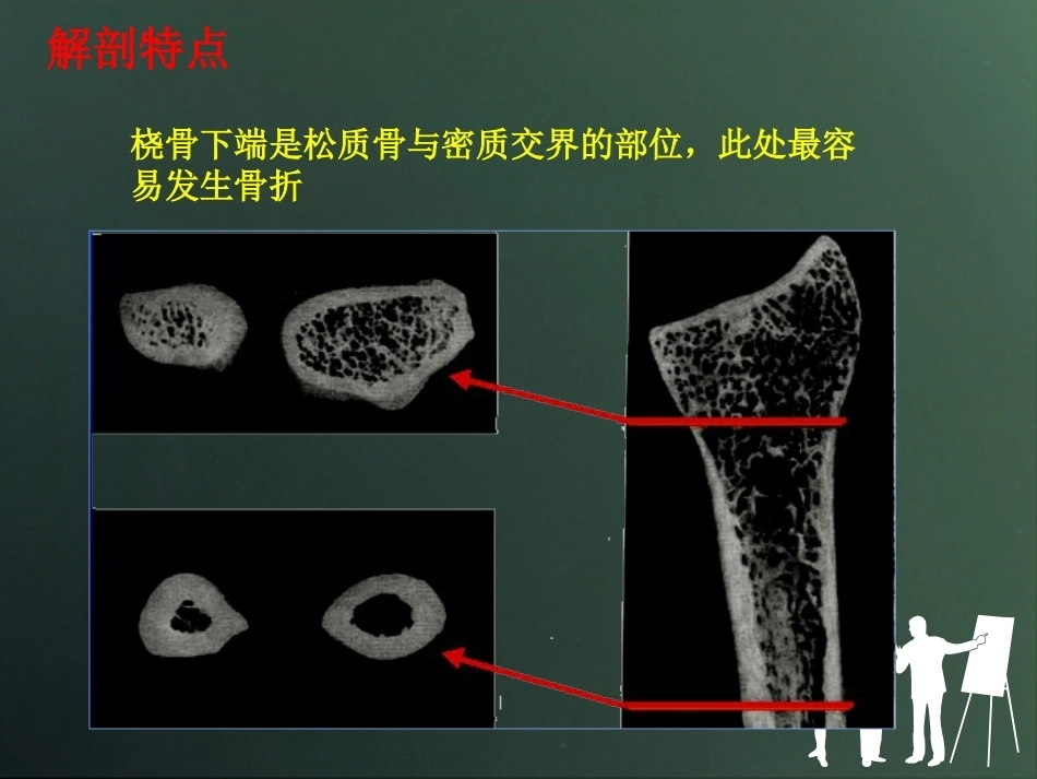 桡骨远端骨折分型_第5页