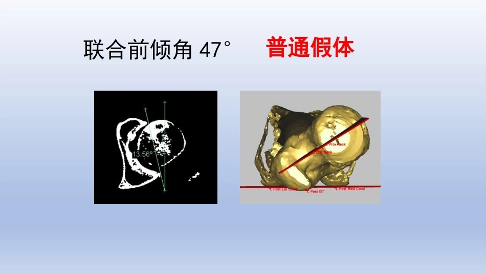 DDH全髋关节置换手术难点及对 策_第13页