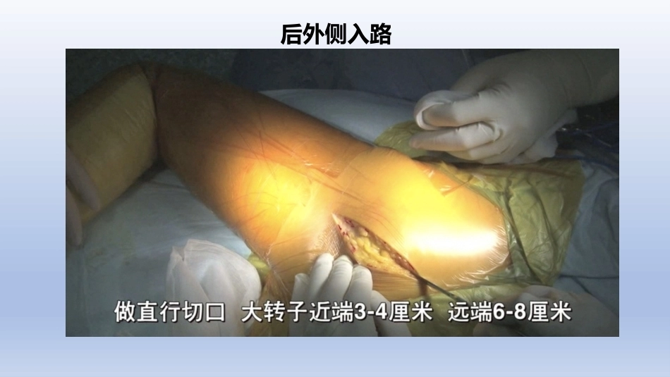 DDH全髋关节置换手术难点及对 策_第14页