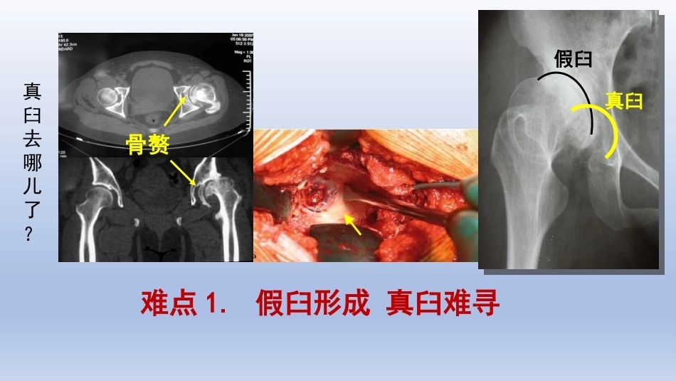 DDH全髋关节置换手术难点及对 策_第4页