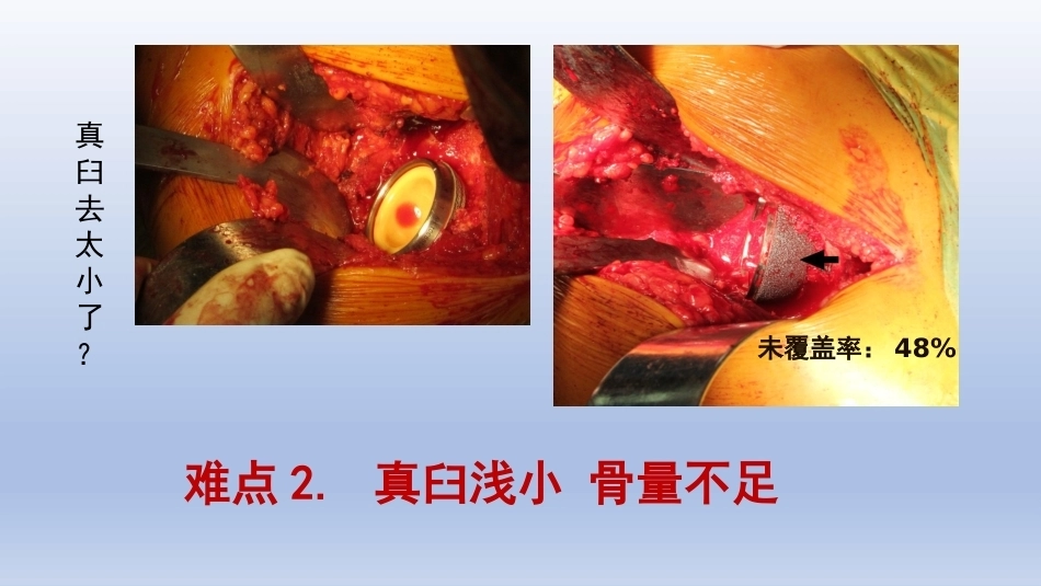 DDH全髋关节置换手术难点及对 策_第5页