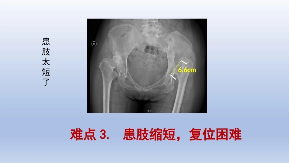 DDH全髋关节置换手术难点及对 策_第6页