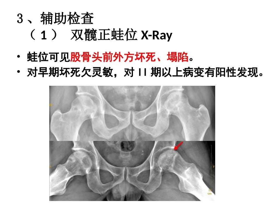 股骨头坏死的诊断及 保髋方法的选择_第12页