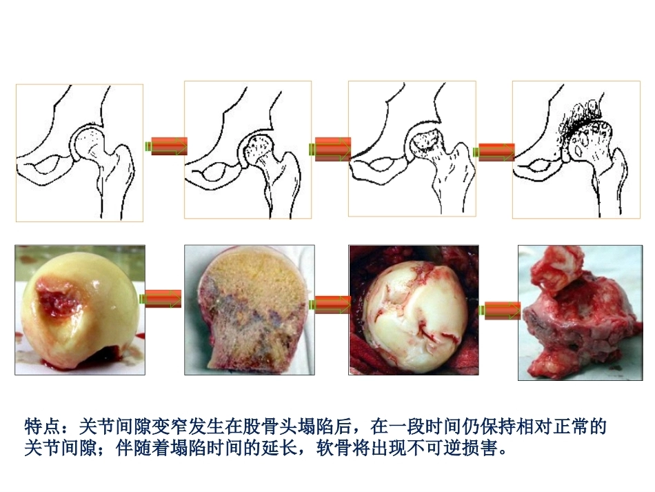 股骨头坏死的诊断及 保髋方法的选择_第4页