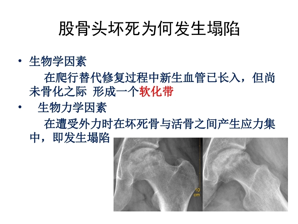 股骨头坏死的诊断及 保髋方法的选择_第6页