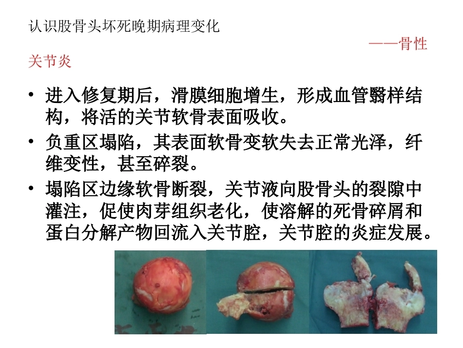 股骨头坏死的诊断及 保髋方法的选择_第8页