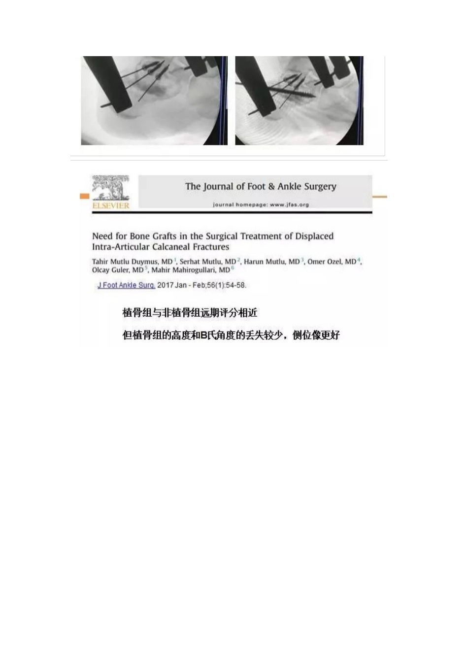 跟骨微创手术的经 验与陷阱_第13页