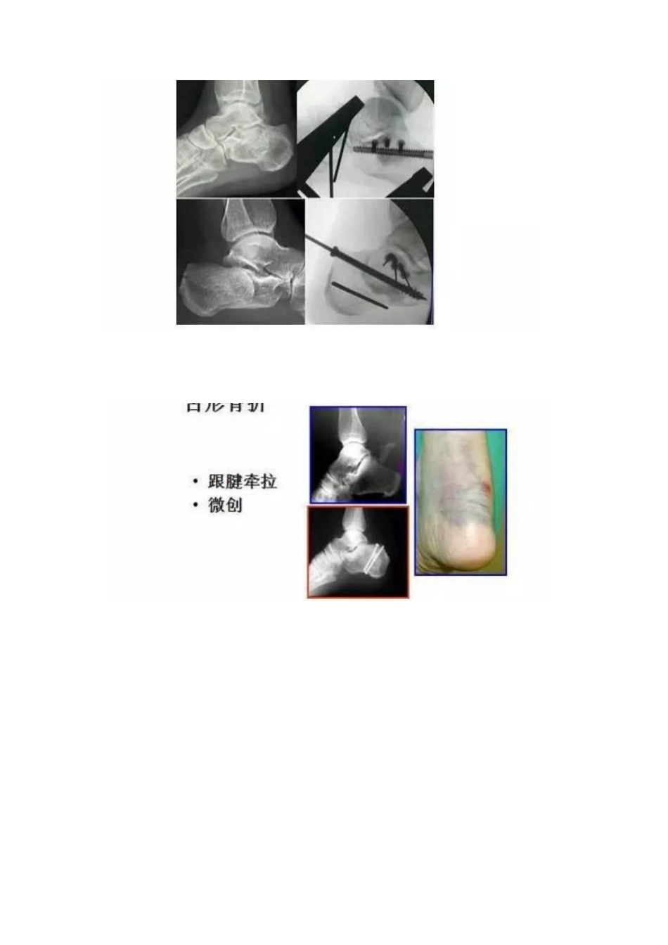 跟骨微创手术的经 验与陷阱_第14页