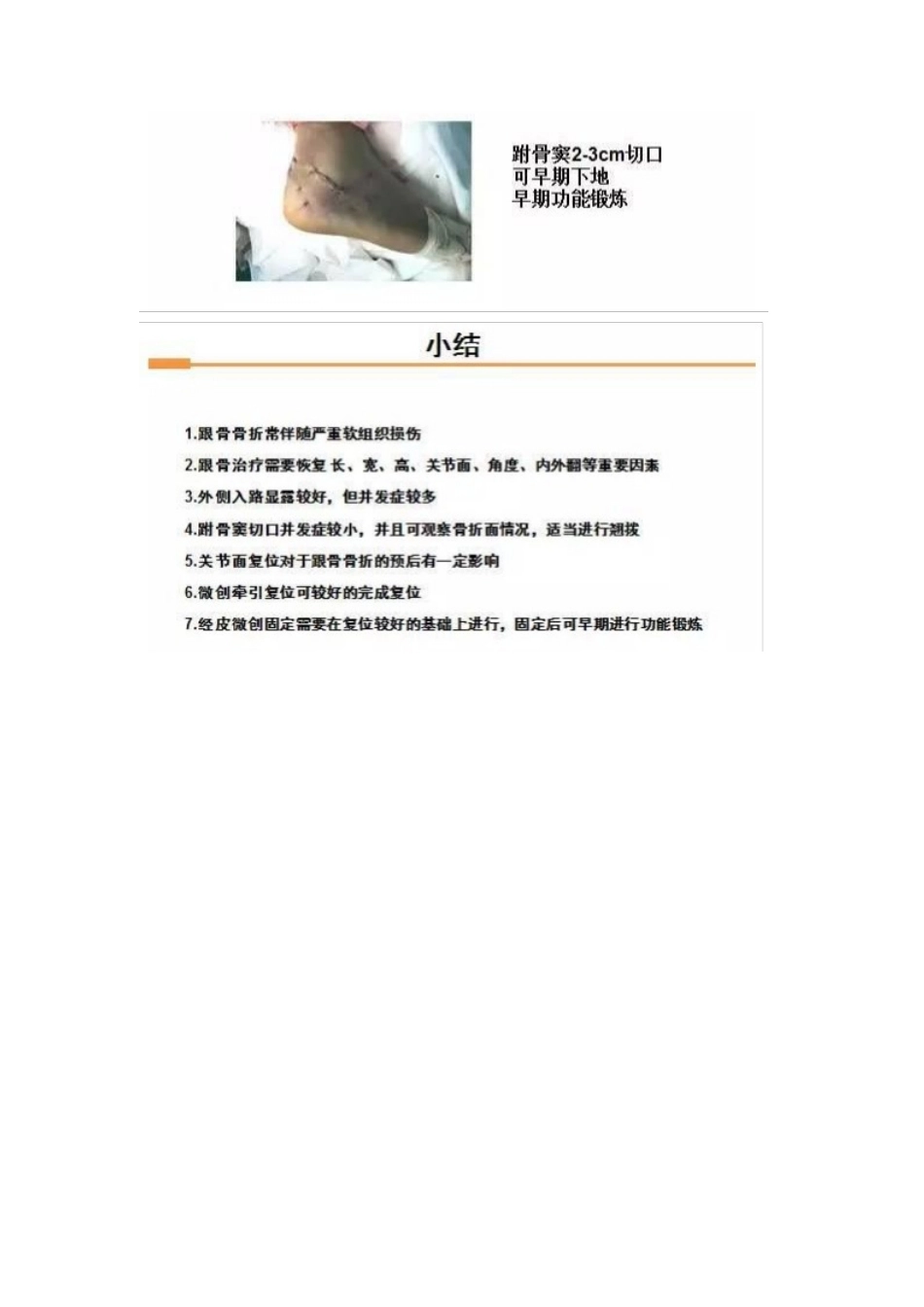 跟骨微创手术的经 验与陷阱_第15页