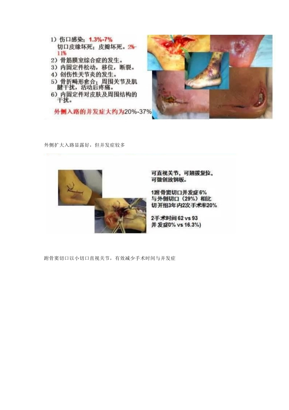跟骨微创手术的经 验与陷阱_第4页