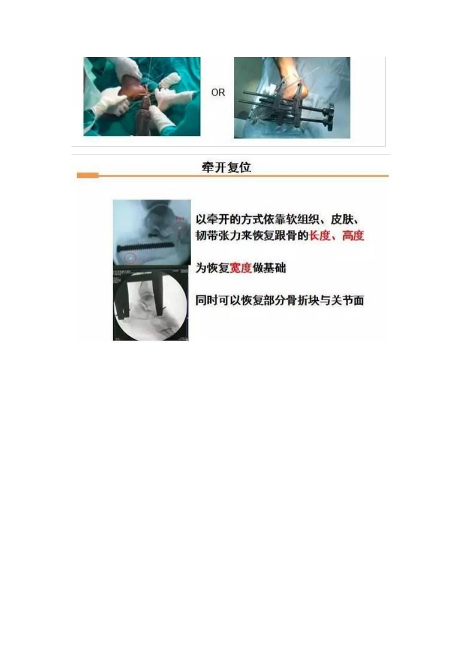 跟骨微创手术的经 验与陷阱_第8页