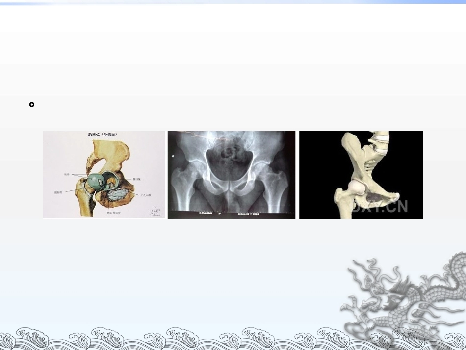 股骨头坏死的分型_第4页