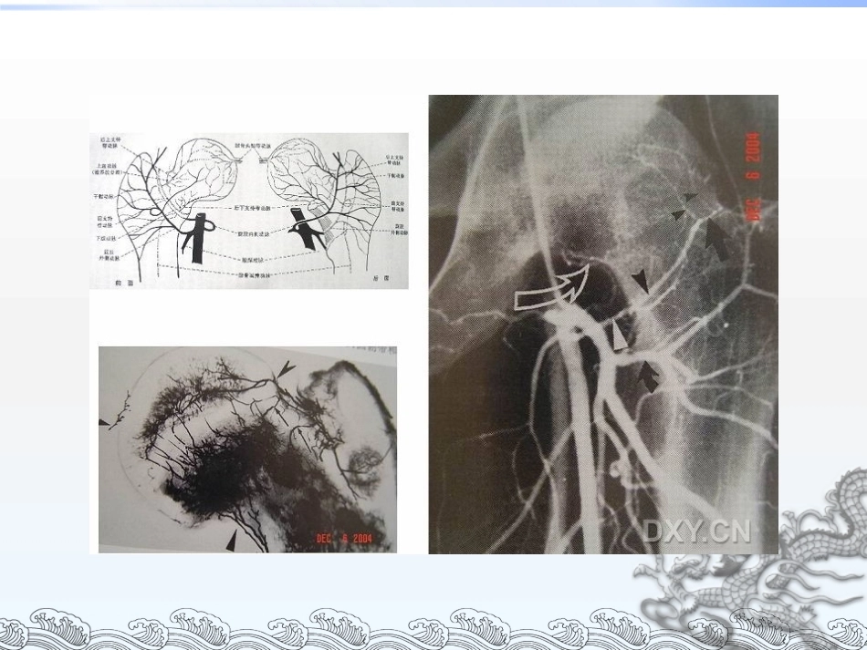 股骨头坏死的分型_第6页