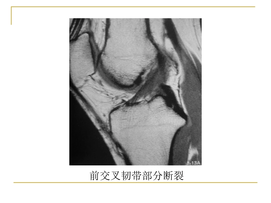 膝关节损伤MRI诊断问 题分析_第10页