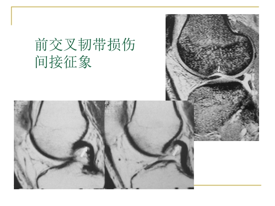 膝关节损伤MRI诊断问 题分析_第13页