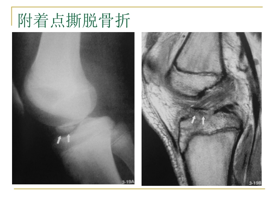 膝关节损伤MRI诊断问 题分析_第14页