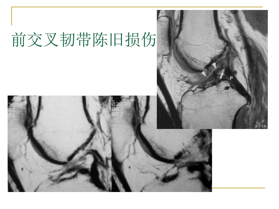 膝关节损伤MRI诊断问 题分析_第15页