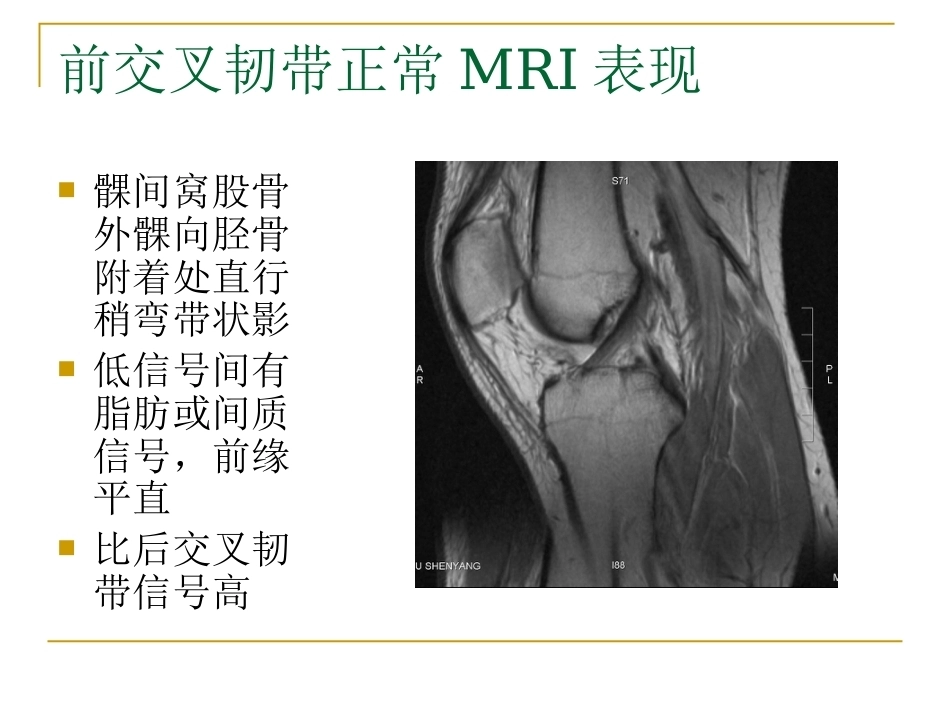 膝关节损伤MRI诊断问 题分析_第4页