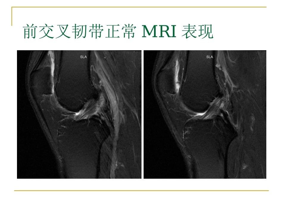 膝关节损伤MRI诊断问 题分析_第6页
