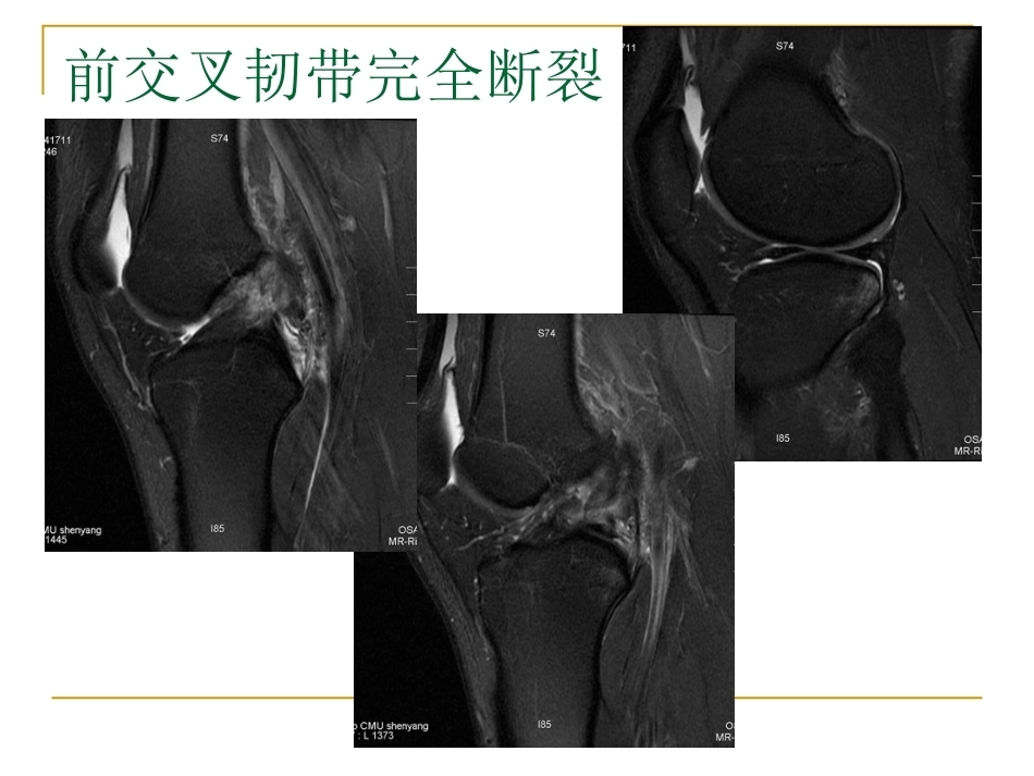 膝关节损伤MRI诊断问 题分析_第7页