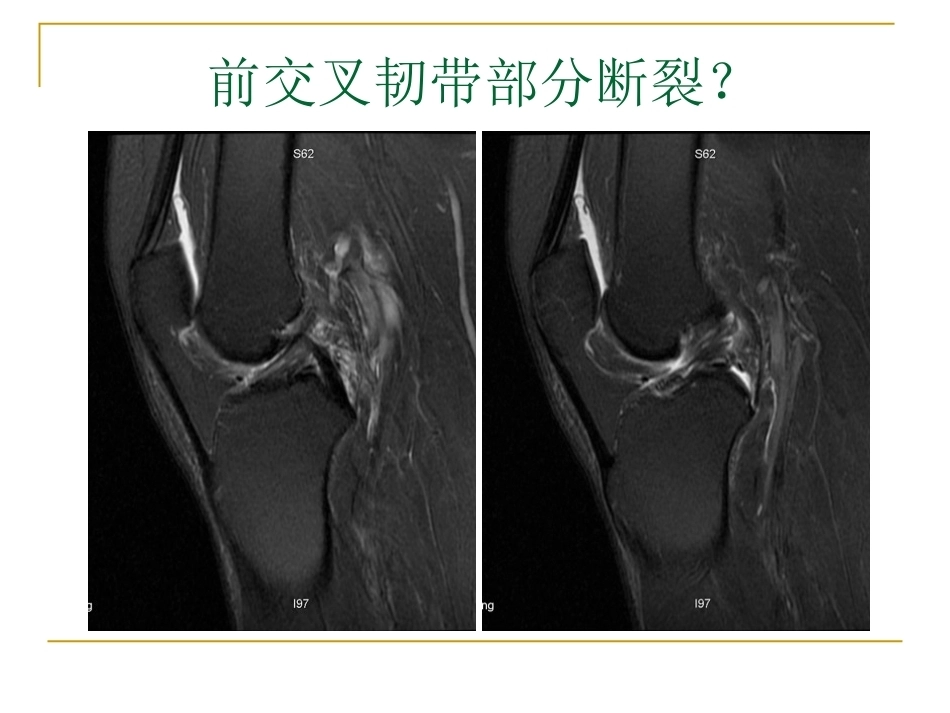 膝关节损伤MRI诊断问 题分析_第8页