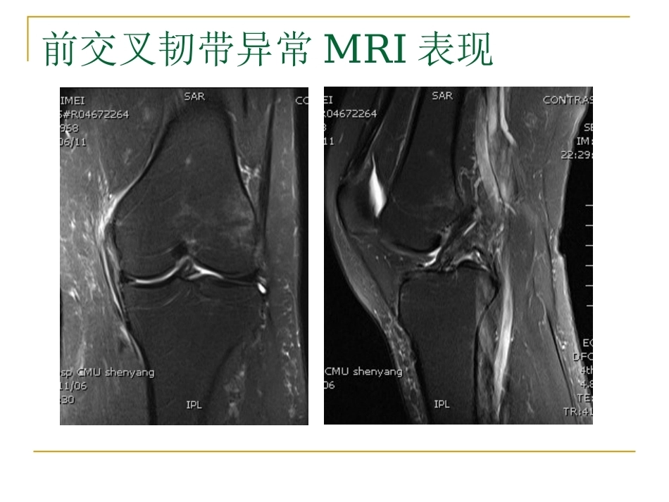 膝关节损伤MRI诊断问 题分析_第9页