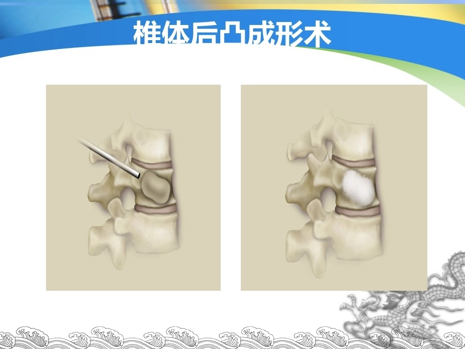 胸腰椎骨折的 微创 手术治疗_第7页