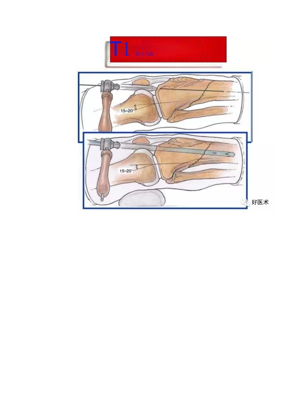 髓内钉治疗胫 骨近端骨折技术_第10页