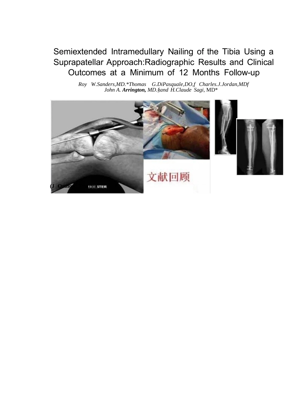 髓内钉治疗胫 骨近端骨折技术_第12页