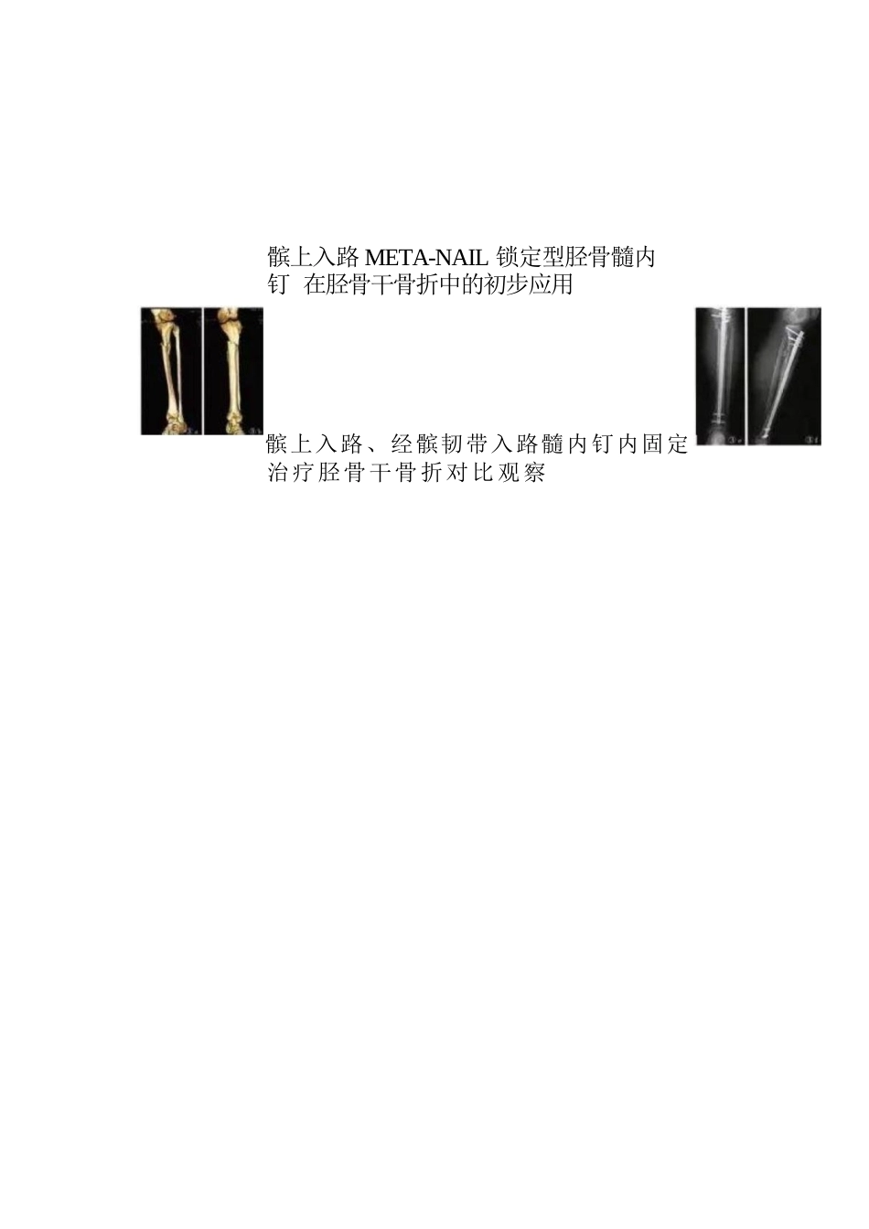 髓内钉治疗胫 骨近端骨折技术_第14页
